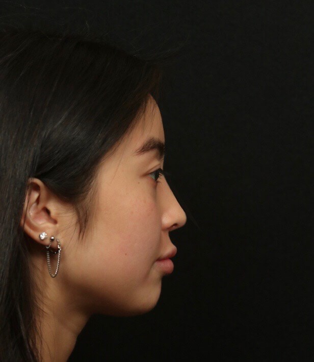 Before and After Rhinoplasty After