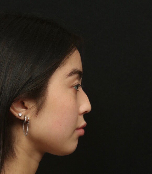 Before and After Rhinoplasty Before