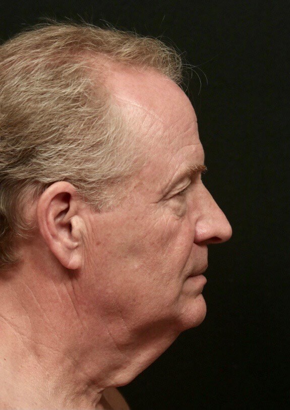 Before and After Side Before