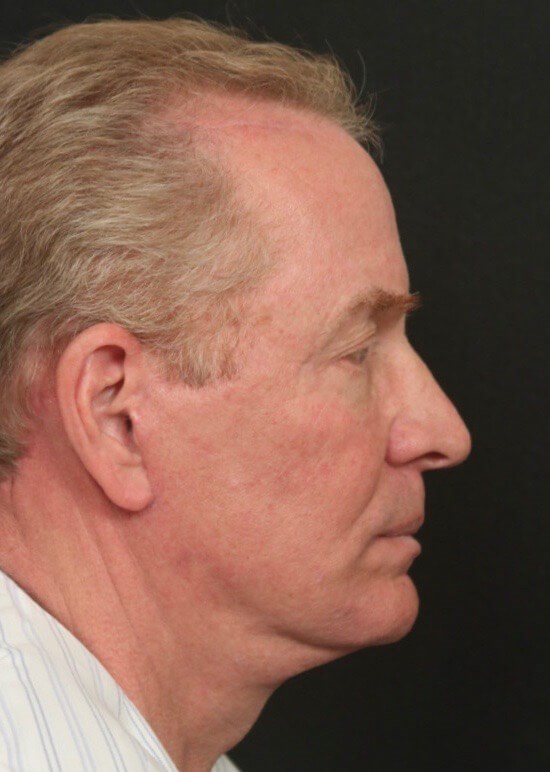 Before and After Side After