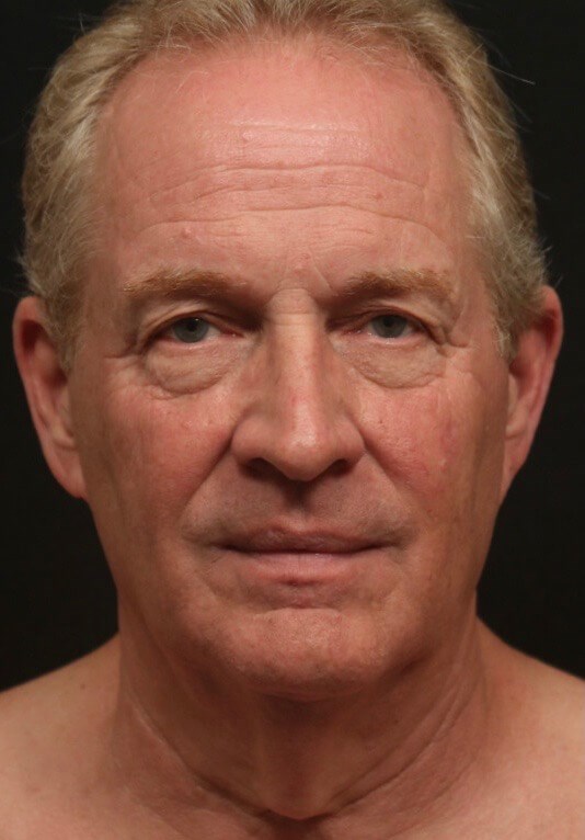 Before and After Front Before