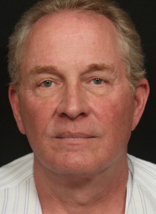 Before and After Front After