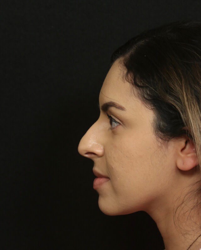 Before and After Rhinoplasty Before