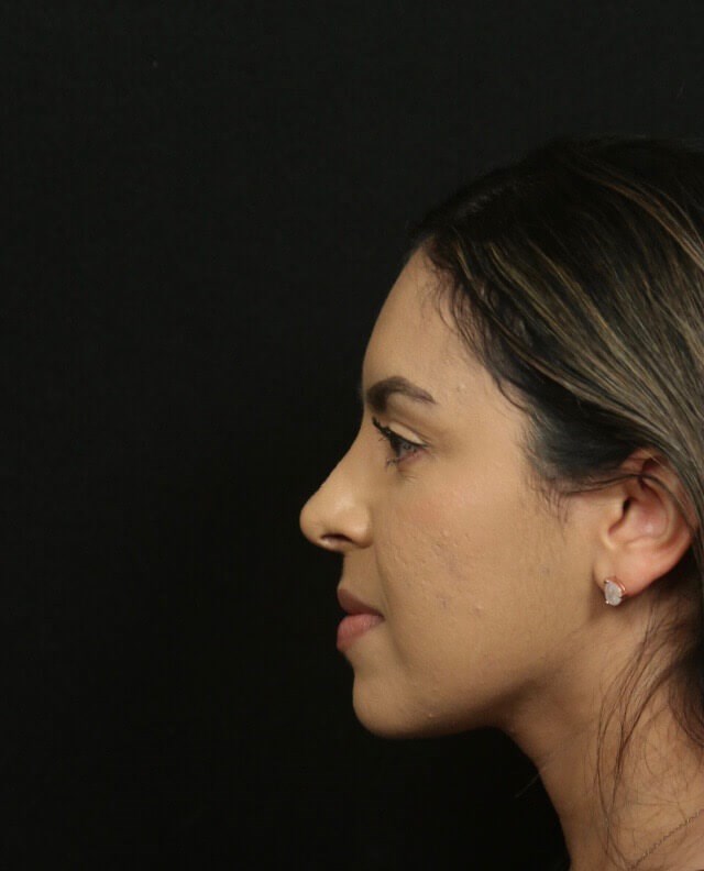 Before and After Rhinoplasty After