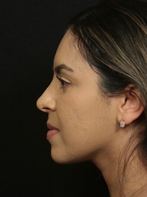 Before and After Rhinoplasty After