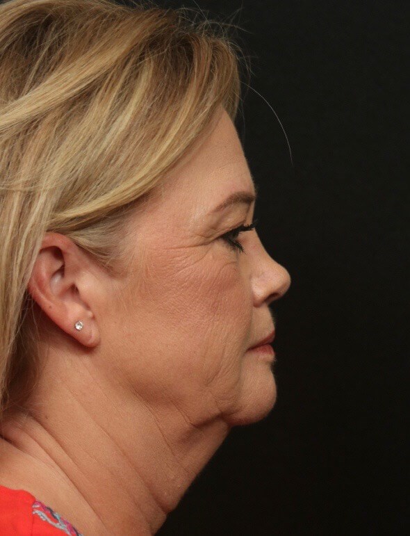 Facelift Before and After Before