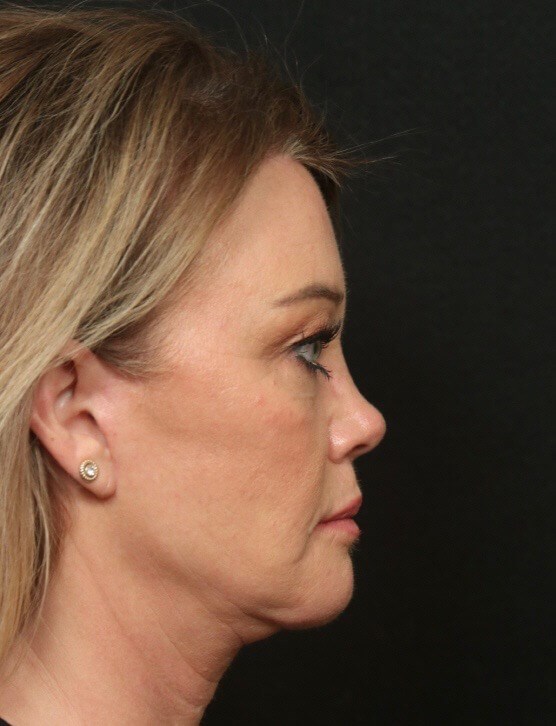 Facelift Before and After After