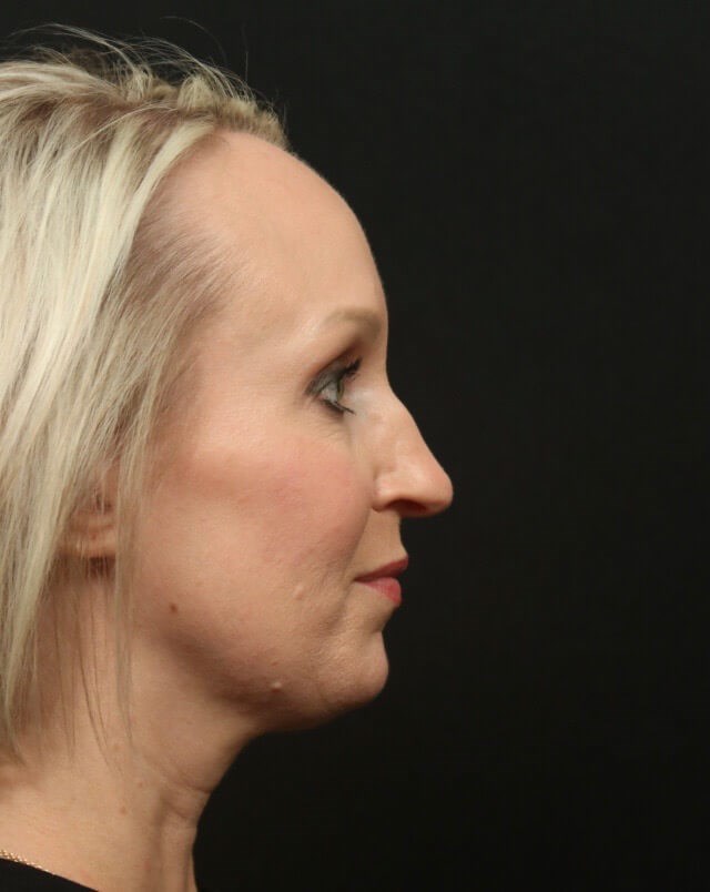 Before and After Rhinoplasty Before