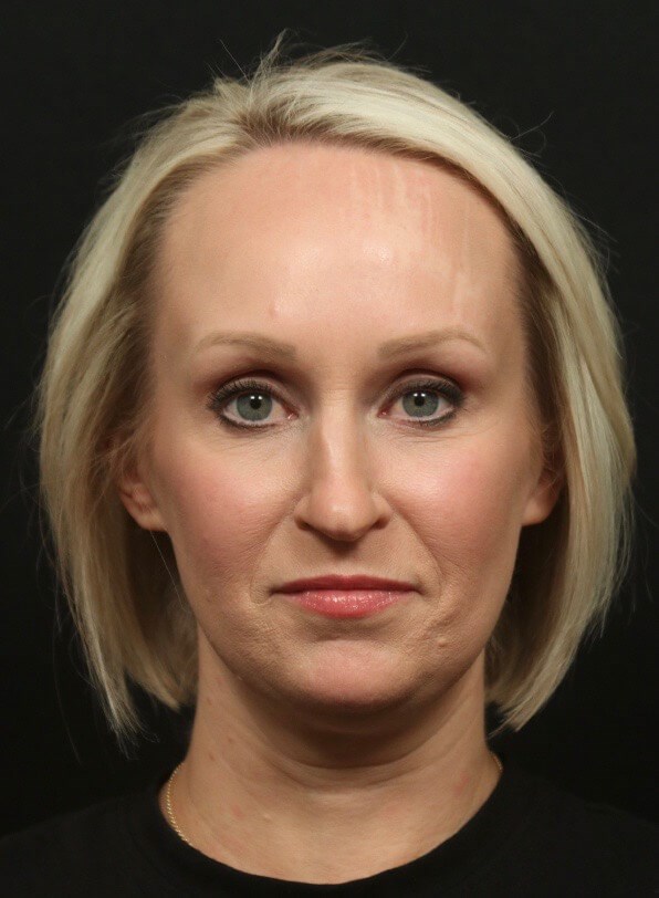 Before and After Rhinoplasty Before