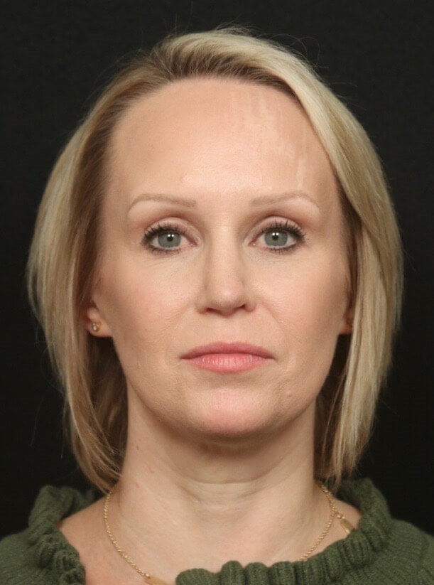 Before and After Rhinoplasty After