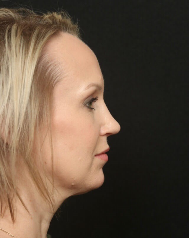Before and After Rhinoplasty After
