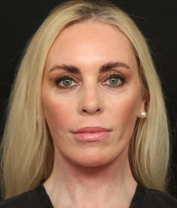 Before and After Facelift After