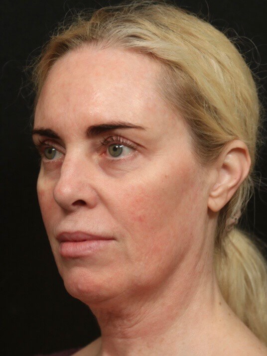 Before & After Face Neck Lift Before