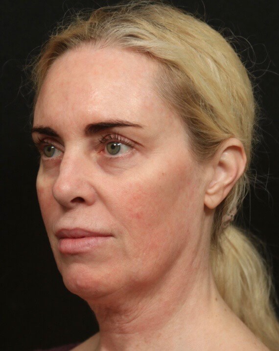 Before and After Facelift Before