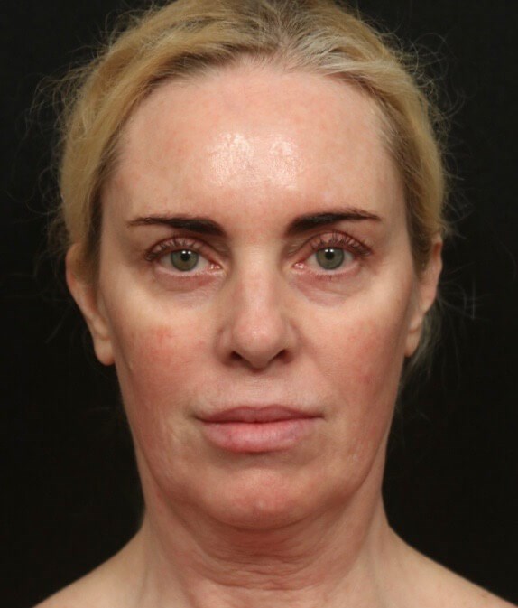 Before and After Facelift Before