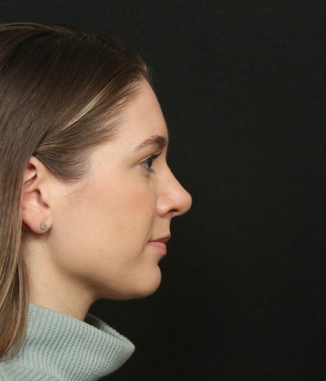 Before and After Rhinoplasty After