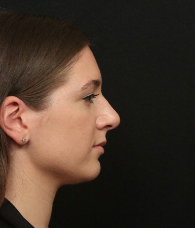Before and After Rhinoplasty Before