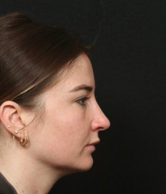 Before and After Rhinoplasty After