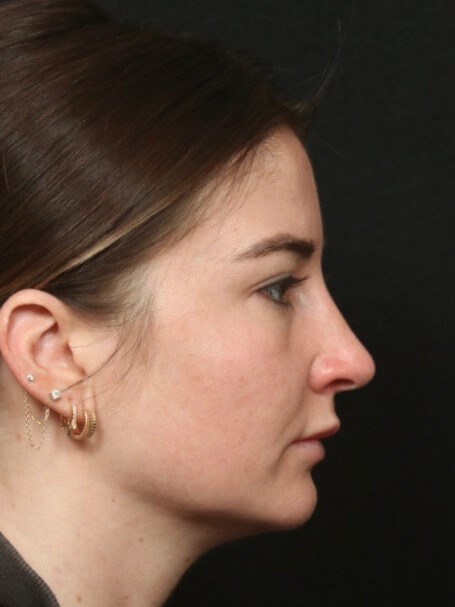 Before and After Rhinoplasty After