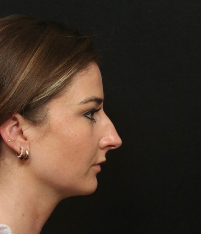 Before and After Rhinoplasty Before