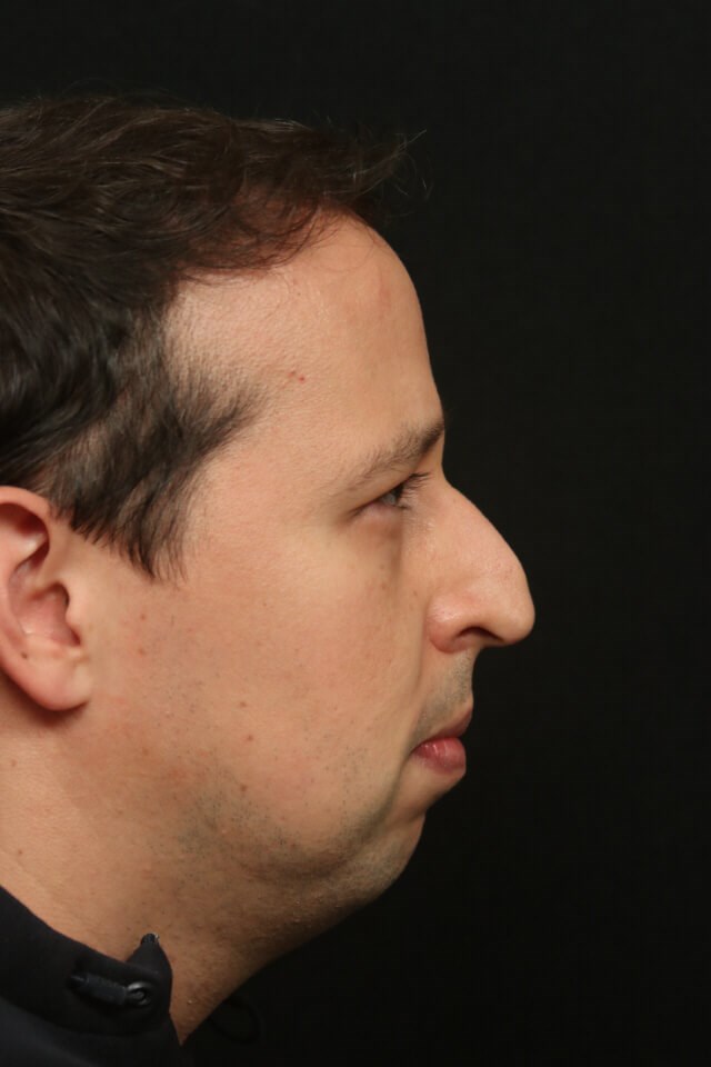 Before and After Rhinoplasty Before