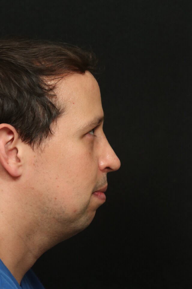 Before and After Rhinoplasty After