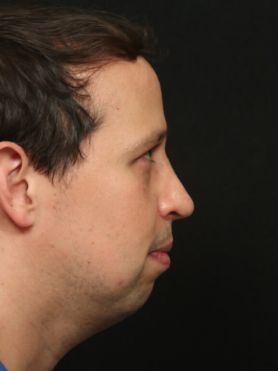 Before and After Rhinoplasty After