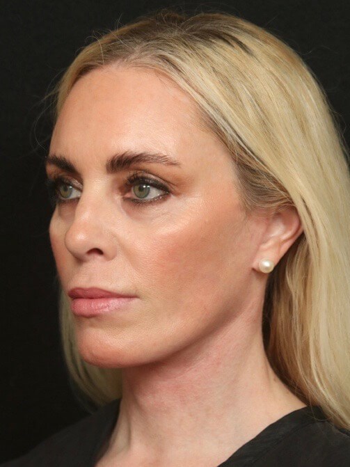 Before & After Face Neck Lift After
