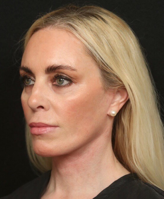 Before and After Facelift After