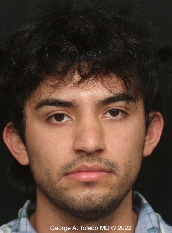 Before and After Otoplasty Before