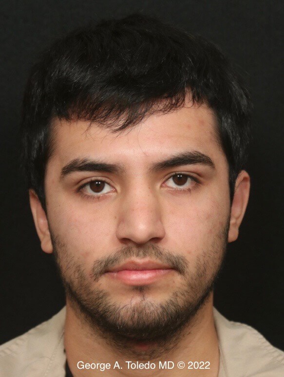 Before and After Otoplasty After