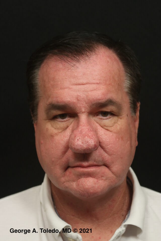 Rhinophyma Before and After Before