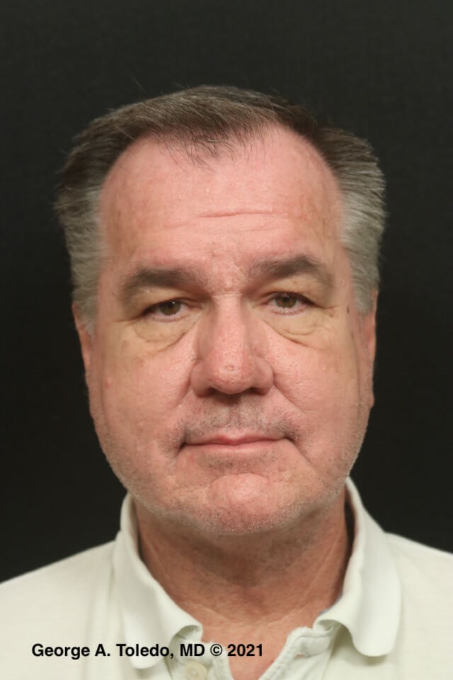 Rhinophyma Before and After After