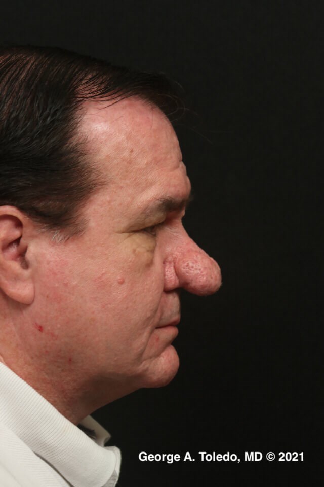 Rhinophyma Before and After Before