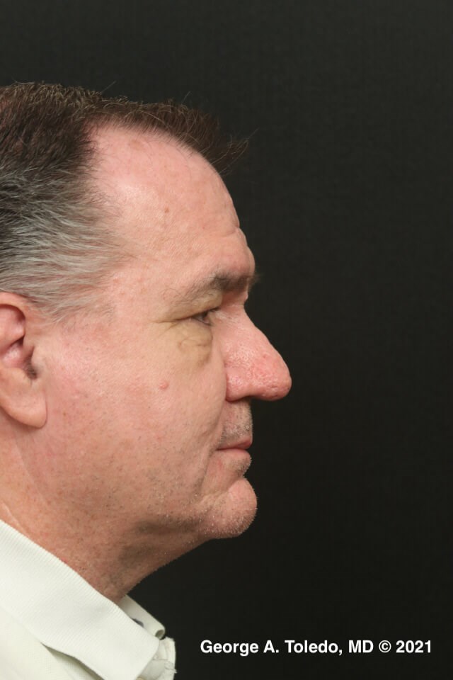 Rhinophyma Before and After After