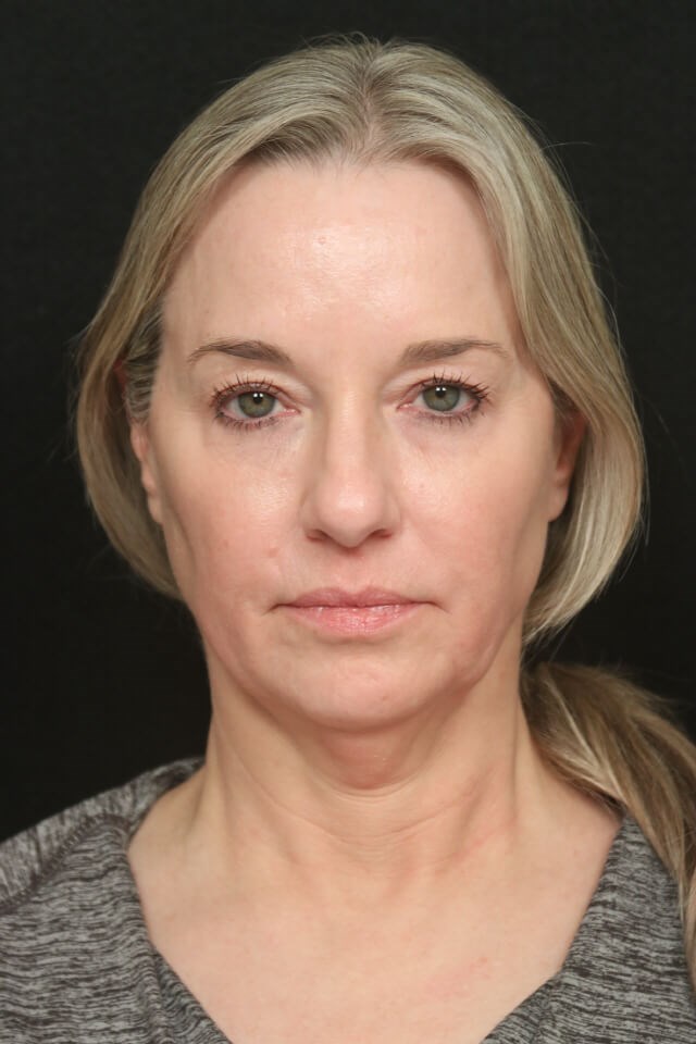 Facelift Before and After Before