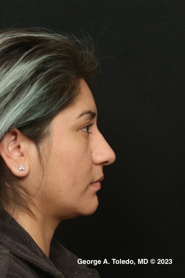 Rhinoplasty Profile Views Before