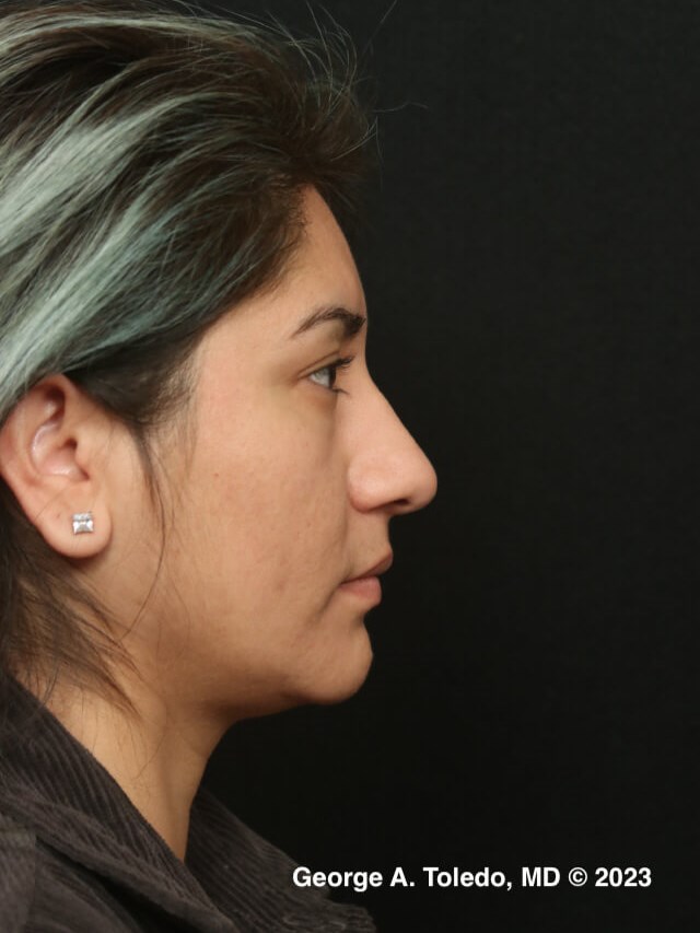 Rhinoplasty Profile Views Before