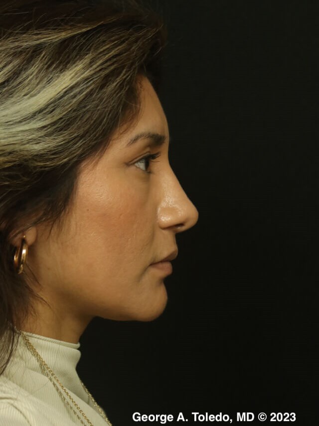 Rhinoplasty Profile Views After