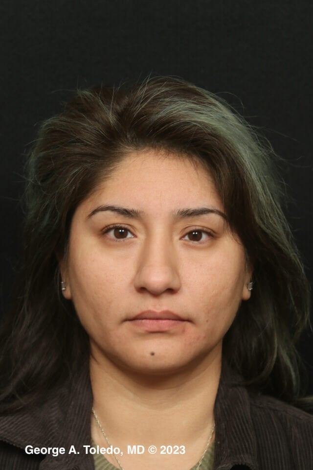 Rhinoplasty Front Views Before