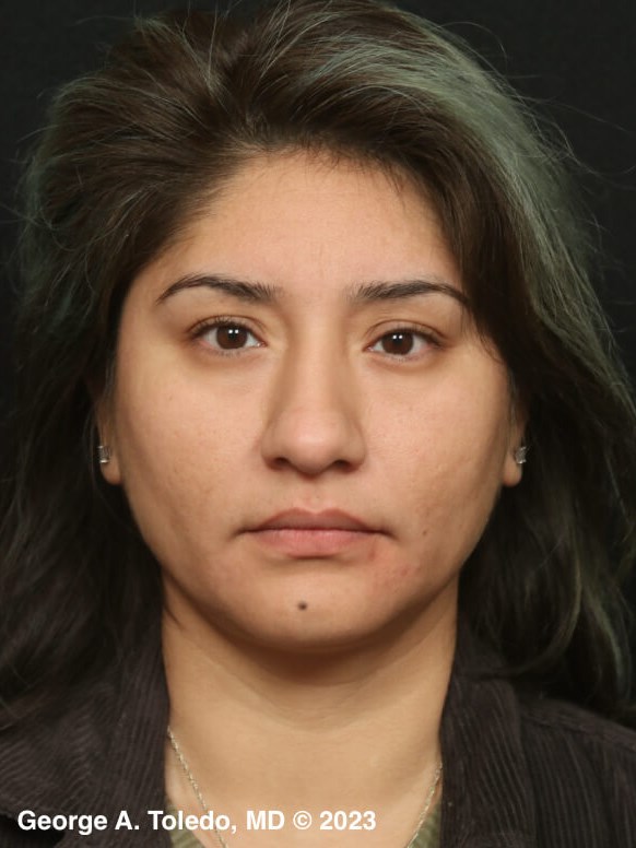 Rhinoplasty Front Views Before