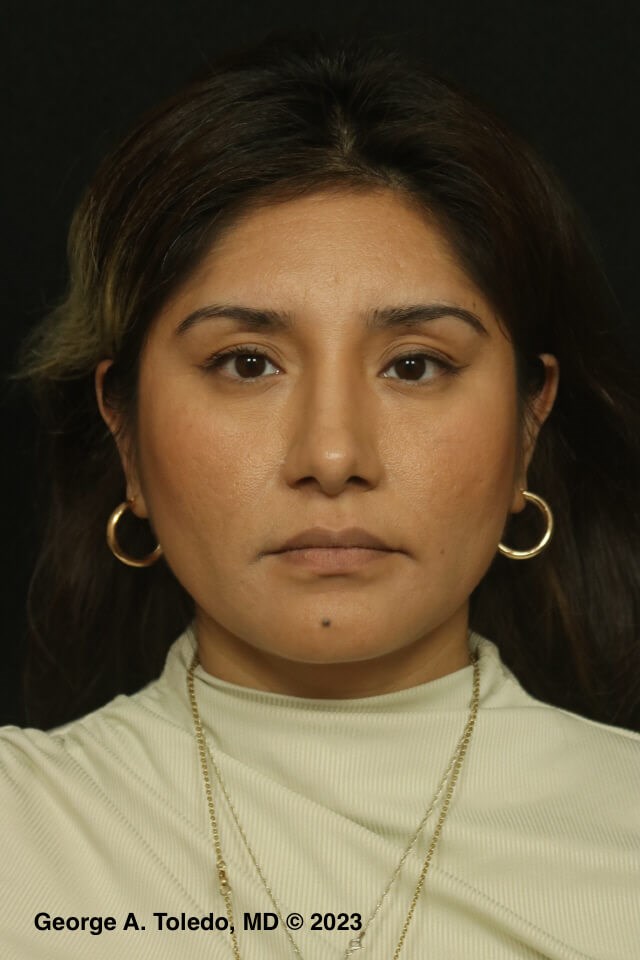 Rhinoplasty Front Views After