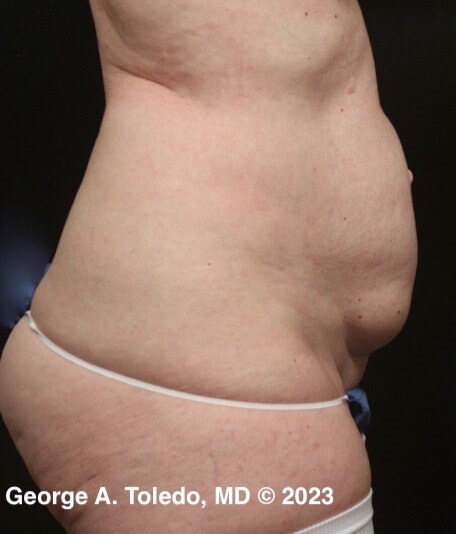 Tummy Tuck Results Before