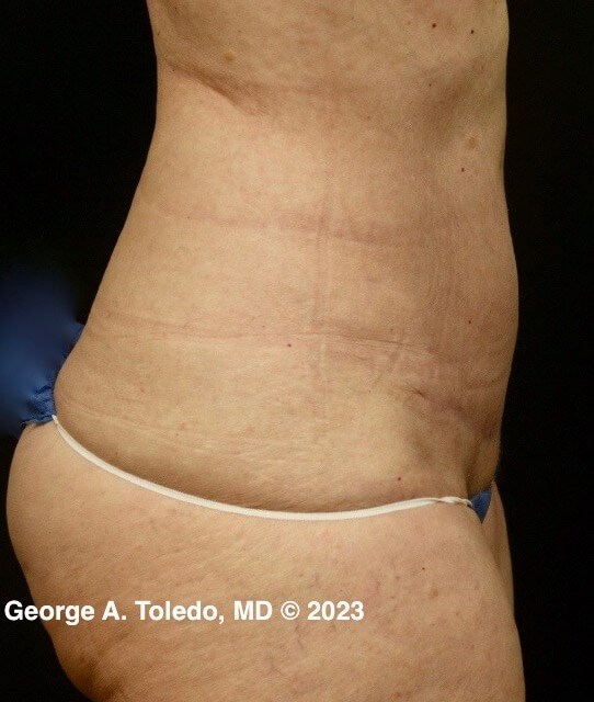 Tummy Tuck Results After