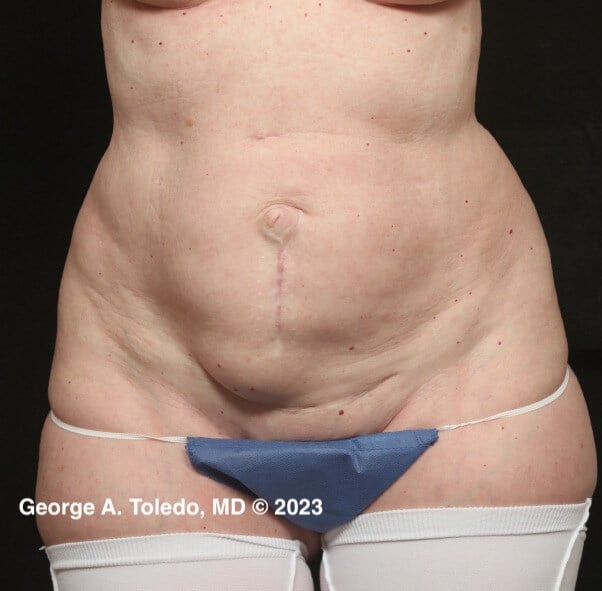 Tummy Tuck Results Before