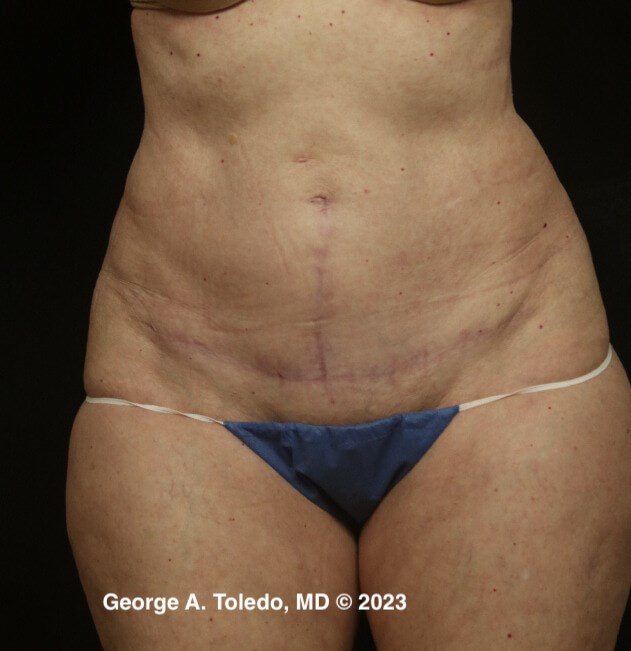 Tummy Tuck Results After