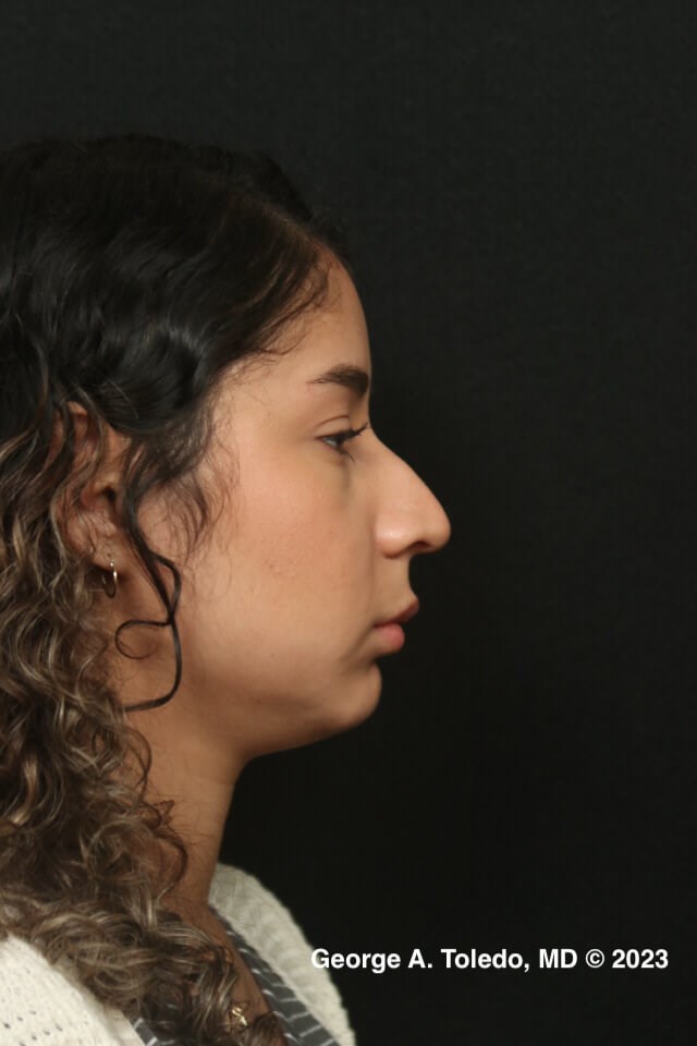 Rhinoplasty Before and After Before