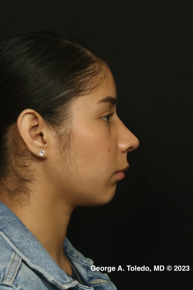 Rhinoplasty Before and After After