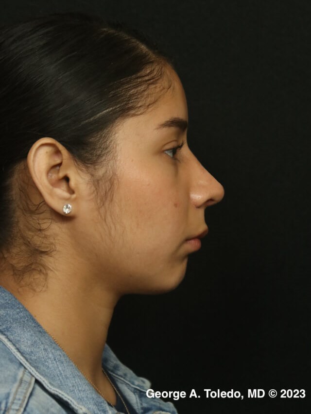 Rhinoplasty Before and After After
