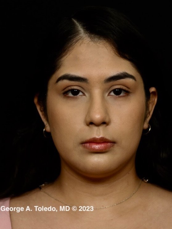 Rhinoplasty Before and After Before